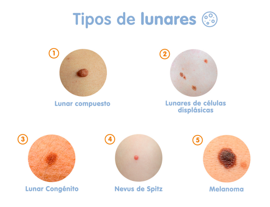 Tipos de lunares Varios tipos de lunares benignos o malignos