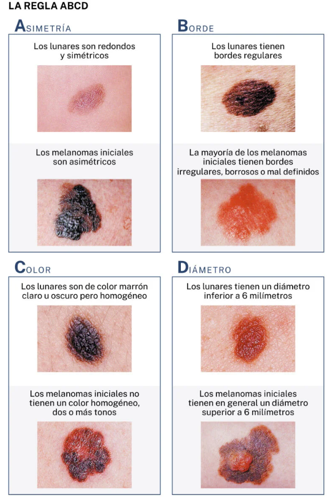 Regla ABCD Tipos de lunares benignos o malignos